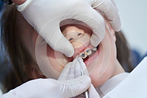 Braces for child teeth correction. Installation and maintenace