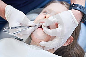 Braces for child teeth correction. Installation and maintenace