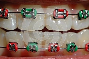 Braces in colour