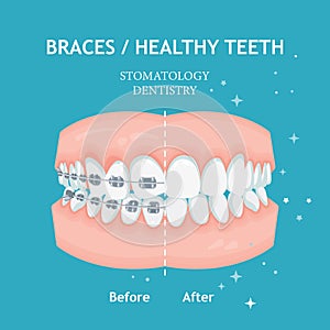 Braces concept. White spots. Stomatology dentistry vector