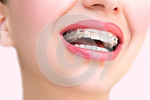 Braces. Dental Care Concept.