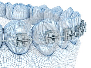 Braces and denture. Wire 3d model illustration