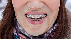 Braces on the girl`s teeth, macro photo teeth, close-up lips,