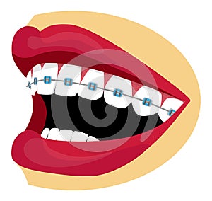 Braces illustration