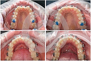 before and after braces are installed. Upper and lower jaw. Correction of teeth using braces