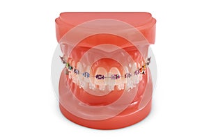 Braces model