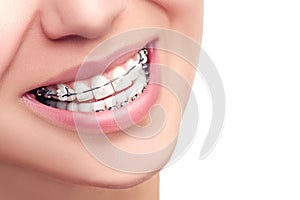 Braces. Orthodontic Dental Care Concept. photo