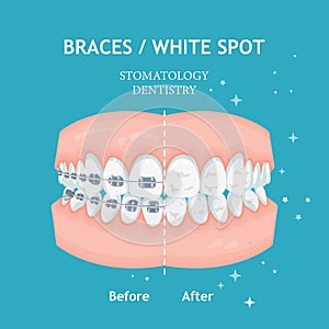 Braces poster. White spots. Stomatology dentistry vector