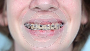 Braces system on teenager's teeth. Close up smiling with dental braces. Caucasian boy braces smile.