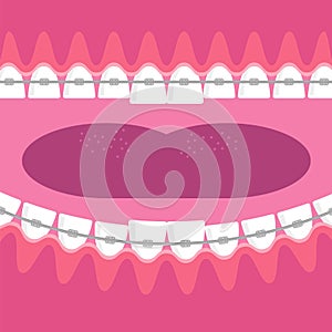 Braces Teeth. Dental Care Background. Orthodontic Treatment. Cartoon Opening Mouth.