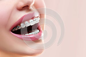 Braces on Teeth. Dental Braces Smile. Orthodontic Treatment. photo