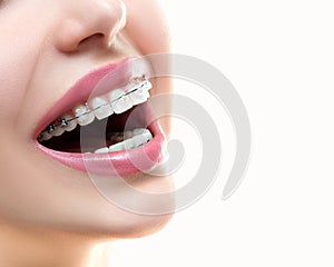 Braces on Teeth. Dental Braces Smile. Orthodontic Treatment. photo