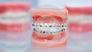 Braces on teeth. lower and upper dental jaw model