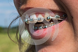 A brace in the mouth