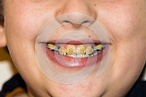 Braces and white teeth of smiling boy medical care