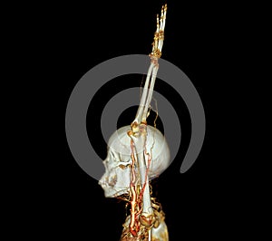 Brachial Arteries of the arm with Upper extremity Bone 3D rendering from CT Scanner