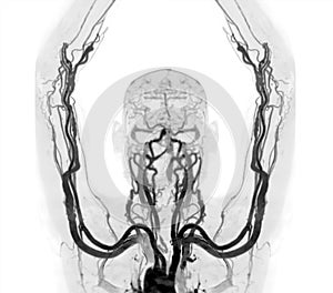 Brachial Arteries of the arm with Upper extremity Bone 3D rendering from CT Scanner