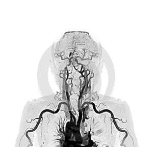 Brachial Arteries of the arm with Upper extremity Bone 3D rendering from CT Scanner