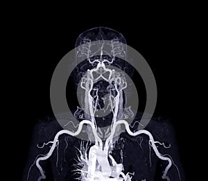 Brachial Arteries of the arm with Upper extremity Bone 3D rendering from CT Scanner