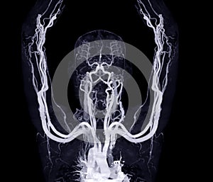 Brachial Arteries of the arm with Upper extremity Bone 3D rendering from CT Scanner