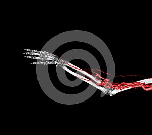 Brachial Arteries of the arm with Upper extremity Bone 3D rendering from CT Scanner