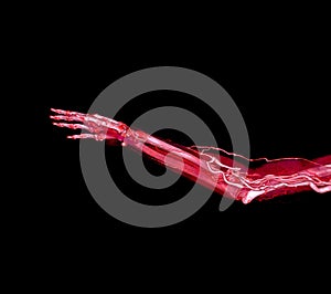 Brachial Arteries of the arm with Upper extremity Bone 3D rendering from CT Scanner