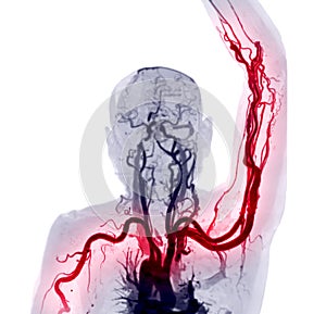 Brachial Arteries of the arm with Upper extremity Bone 3D rendering from CT Scanner photo