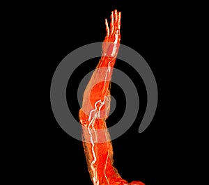 Brachial Arteries of the arm with Upper extremity Bone 3D rendering from CT Scanner photo