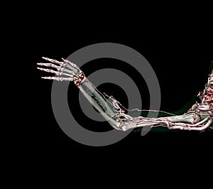 Brachial Arteries of the arm with Upper extremity Bone 3D rendering from CT Scanner photo
