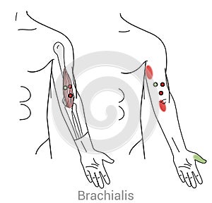 Brachialis trigger points and upper arm pain photo