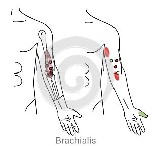 Brachialis trigger points and upper arm pain