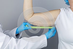 Brachioplasty. Plastic arms, dangling skin at the elbow. An older woman shows the surgeon problem areas of the forearm.