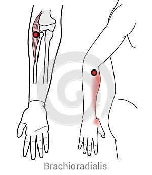 Brachioradialis Trigger points can cause pain down the thumb side of arm from elbow to thumb.