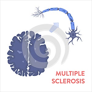 Brain affected by multiple sclerosis, MRI scan illustration photo
