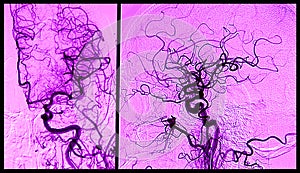 Brain angiograhy, arteriography