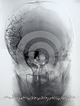 Brain angiography, arteriography