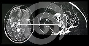 Brain angiography. CT-scan reconstruction. Malformation