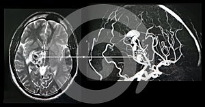 Brain angiography. CT-scan reconstruction. Malformation photo