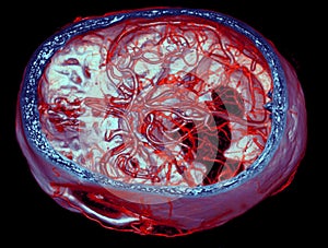 Brain arteries, CT images