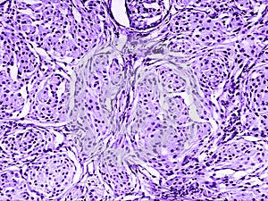 Brain astrocytoma of a human photo