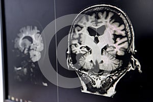 Brain atrophy for education and diagnostic