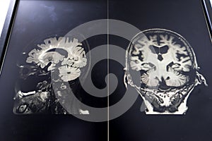 Brain atrophy for education and diagnostic