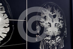 Brain atrophy for education and diagnostic