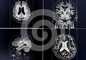 Brain atrophy for education and diagnostic