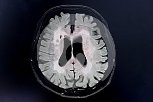 Brain atrophy for education and diagnostic