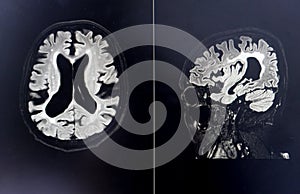 Brain atrophy for education and diagnostic