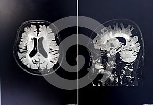 Brain atrophy for education and diagnostic