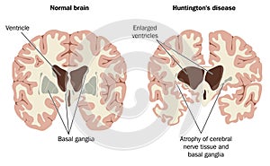 Brain atrophy in Huntingtons disease