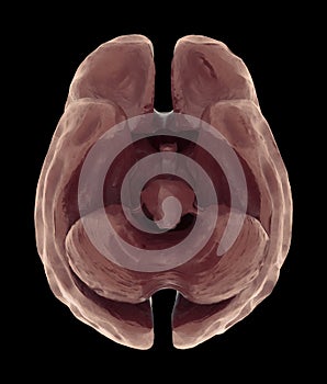 Brain Atrophy Or Severe Shrinkage Of The Brain Caused By Dementia And Alzheimer photo