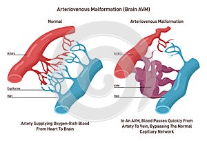 Brain AVM. Tangled blood vessels that connects arteries and veins